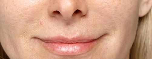 Lip Injections after procedure