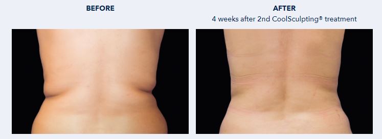 Coolsculpting Love Handles Before and after - Dr NIRDOSH