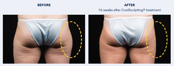 Coolsculpting Before and After Hips Butt - Dr NIRDOSH