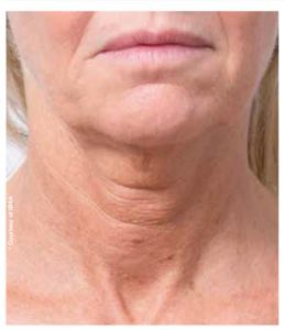 PROFHILO NECK BEFORE AND AFTER - DR NIRDOSH CLINIC