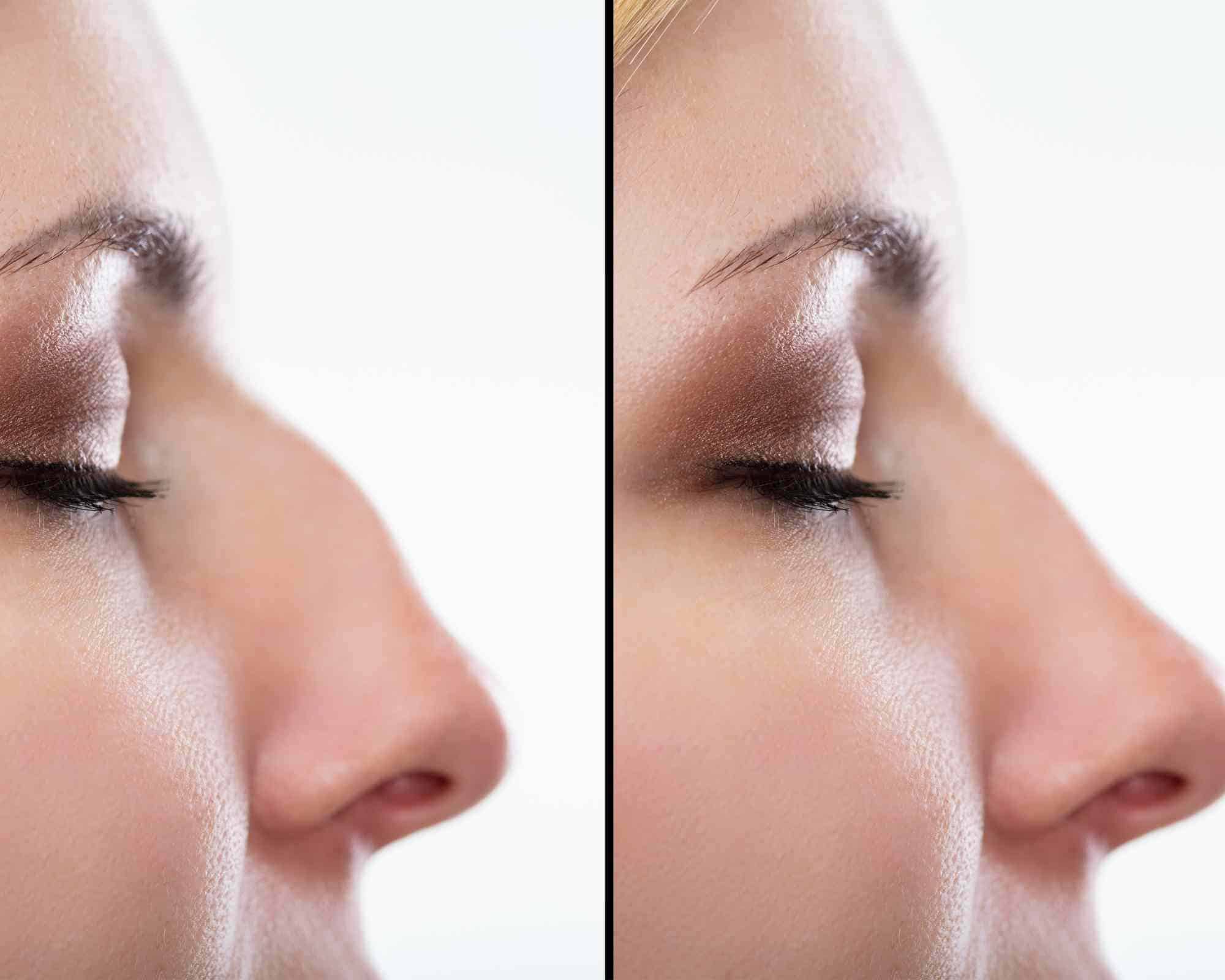 NON SURGCIAL RHINOPLASTY RESULTS