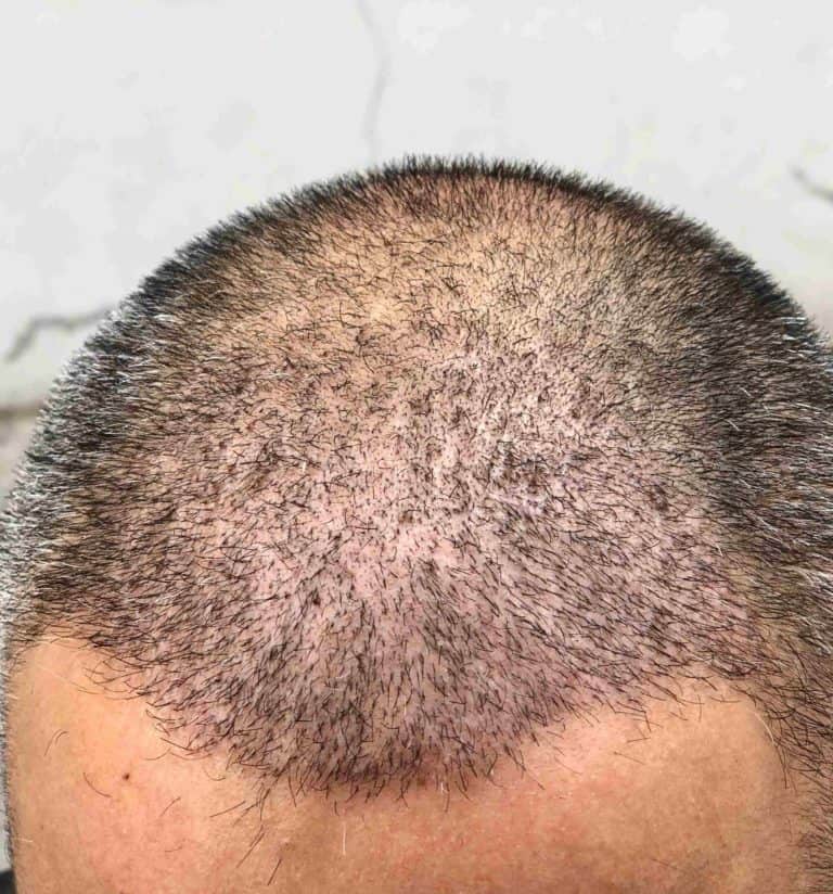 Hair Transplant Dubai Results DR NIRDOSH CLINIC DUBAI