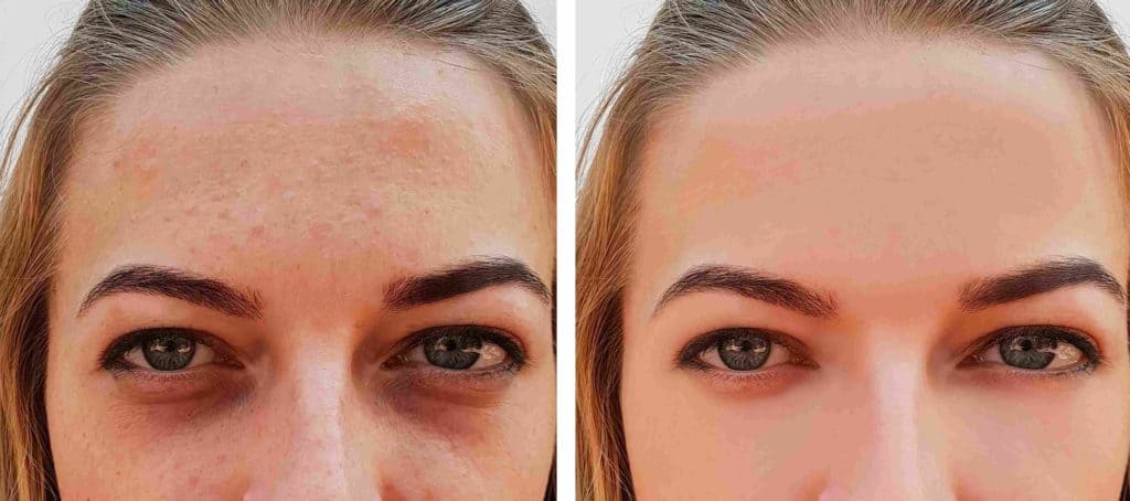 Under Eye Filler Before and After Results