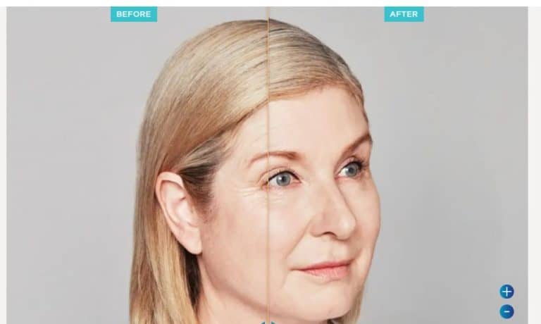 Results Restylane Injections