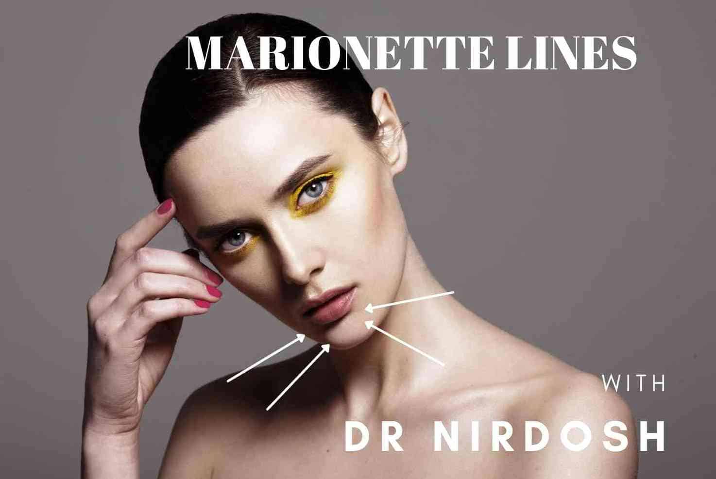 Marionette Lines | Dr Nirdosh