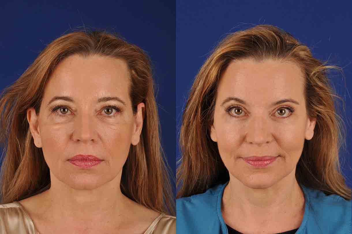 What is BROW LIFT Your Essential Guide Endoscopic Brow Lift in Dubai