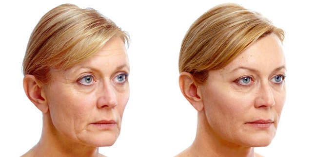 skin tightening, face tight to look good, tighten Face Skin and loose neck skin at 40.