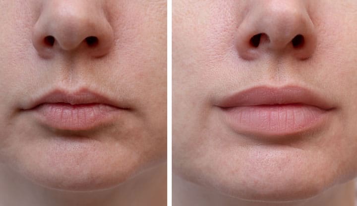 Is It Safe To Get Lip Fillers - Can I Get Lip Fillers While Pregnant?